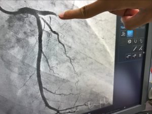Artériopathie chronique