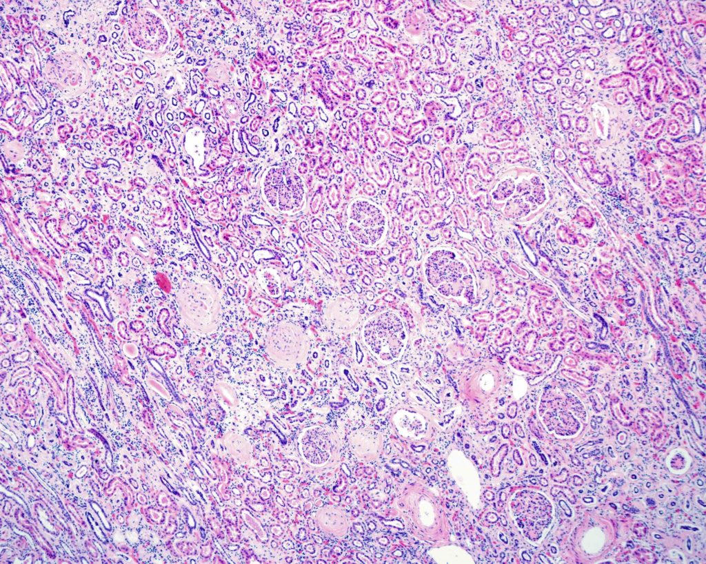 Néphropathie chronique grave